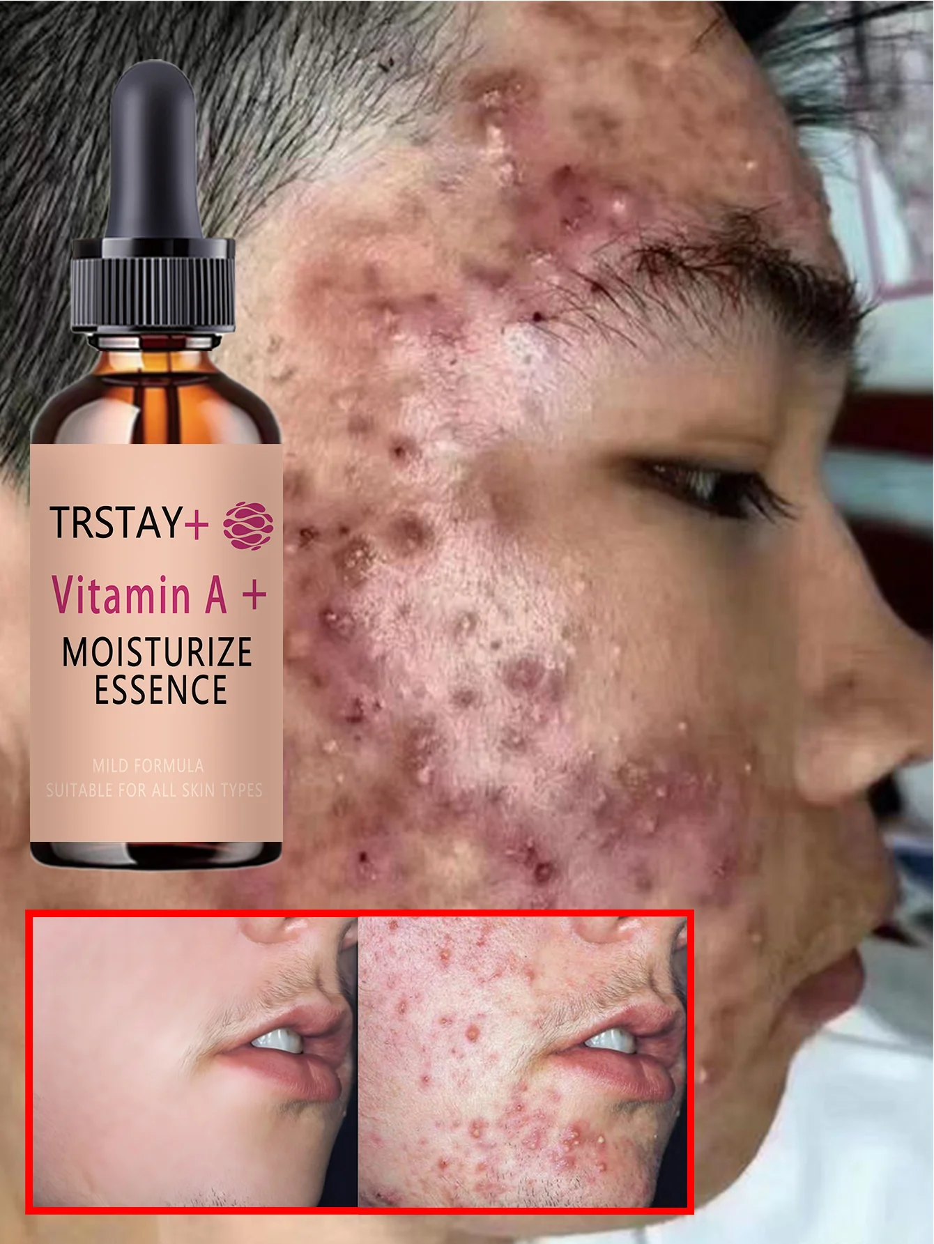 Acne-Fighting Essence, Fragrance-Free Skincare Product, With Plant Extracts, Gentle & Non-Irritating, Keeps Skin Hydrated, Light - Image 3