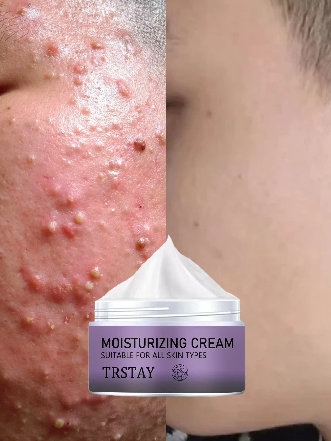 

Успокаивающий увлажняющий крем для лица, склонная кожа от прыщей, глубокое питание, сухая потрескавшаяся плотная кожа, нежно регулирует текстуру лица, улучшает r