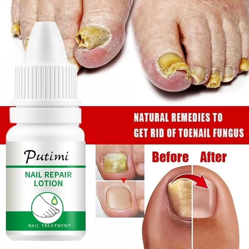 Fungal Nail Treatment Oil Foot Repair Essence เจลกําจัดเชื้อราเล็บเท้า ครีมป้องกันการติดเชื้อ Fungal Nail Removal