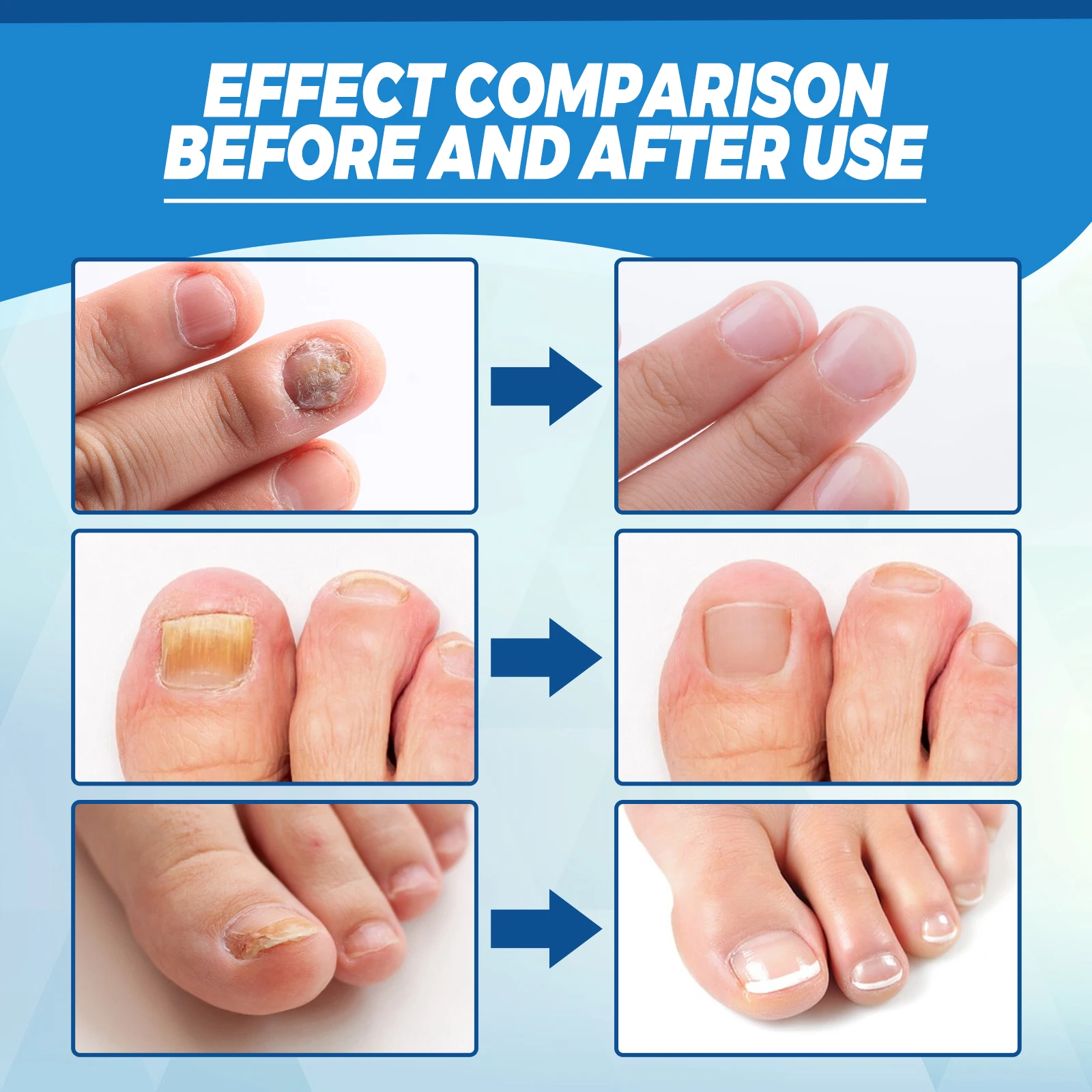 Fungal Nail Laser Device Repair Fast Nails Fungus Onychomycosis