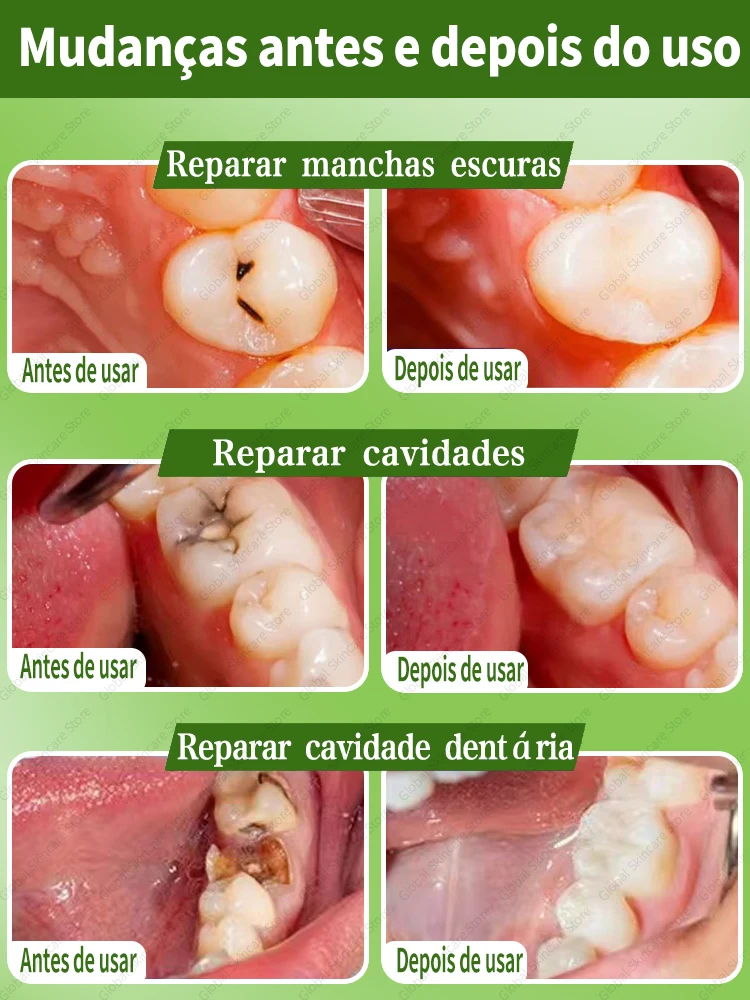 Tooth decay Repair Repairing Cavities Protecting Anti Caries