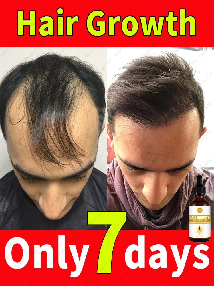 

98% of customers repurchase, have more and more hair, say goodbye to baldness