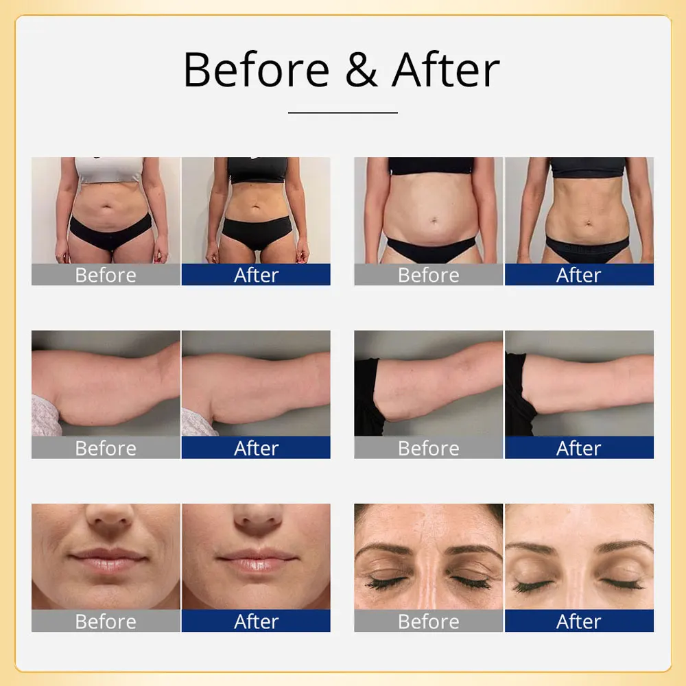 US 40K EMS Cavitation Body Sculpting RF Radiofrequency Skin Tightening And Lifting Muscle Stimulator Body Slimming Beauty Mac