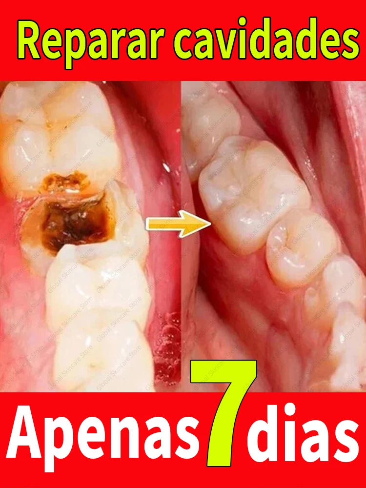 Tooth decay Repair Repairing Cavities Protecting Anti Caries