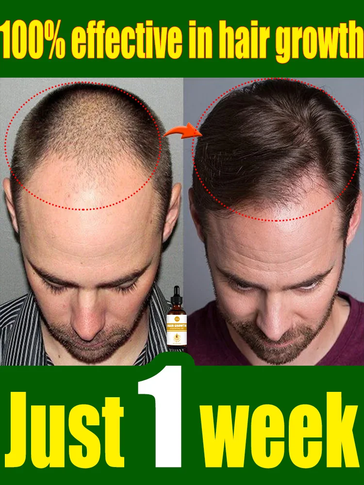 

98% of customers repurchase, have more and more hair, say goodbye to baldness