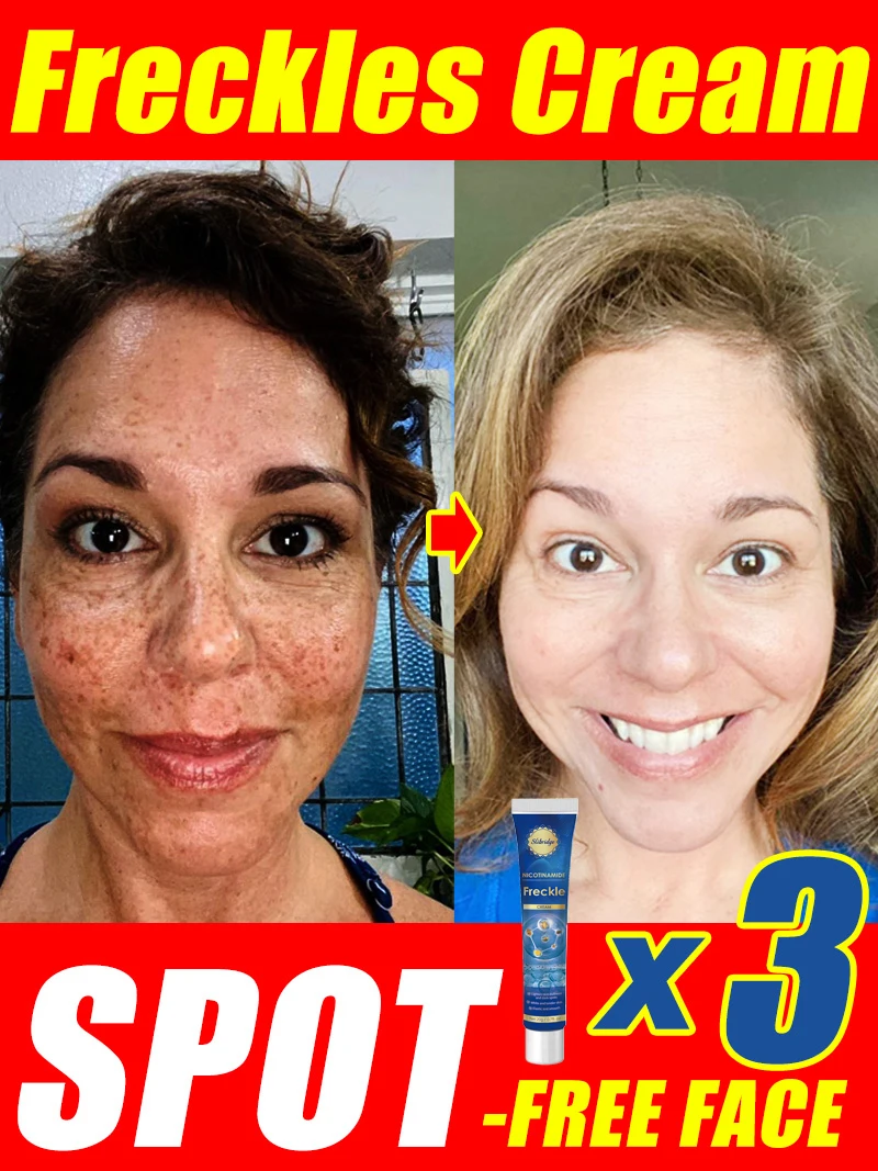 Lightening Facial Freckles Melasma Dark Spots