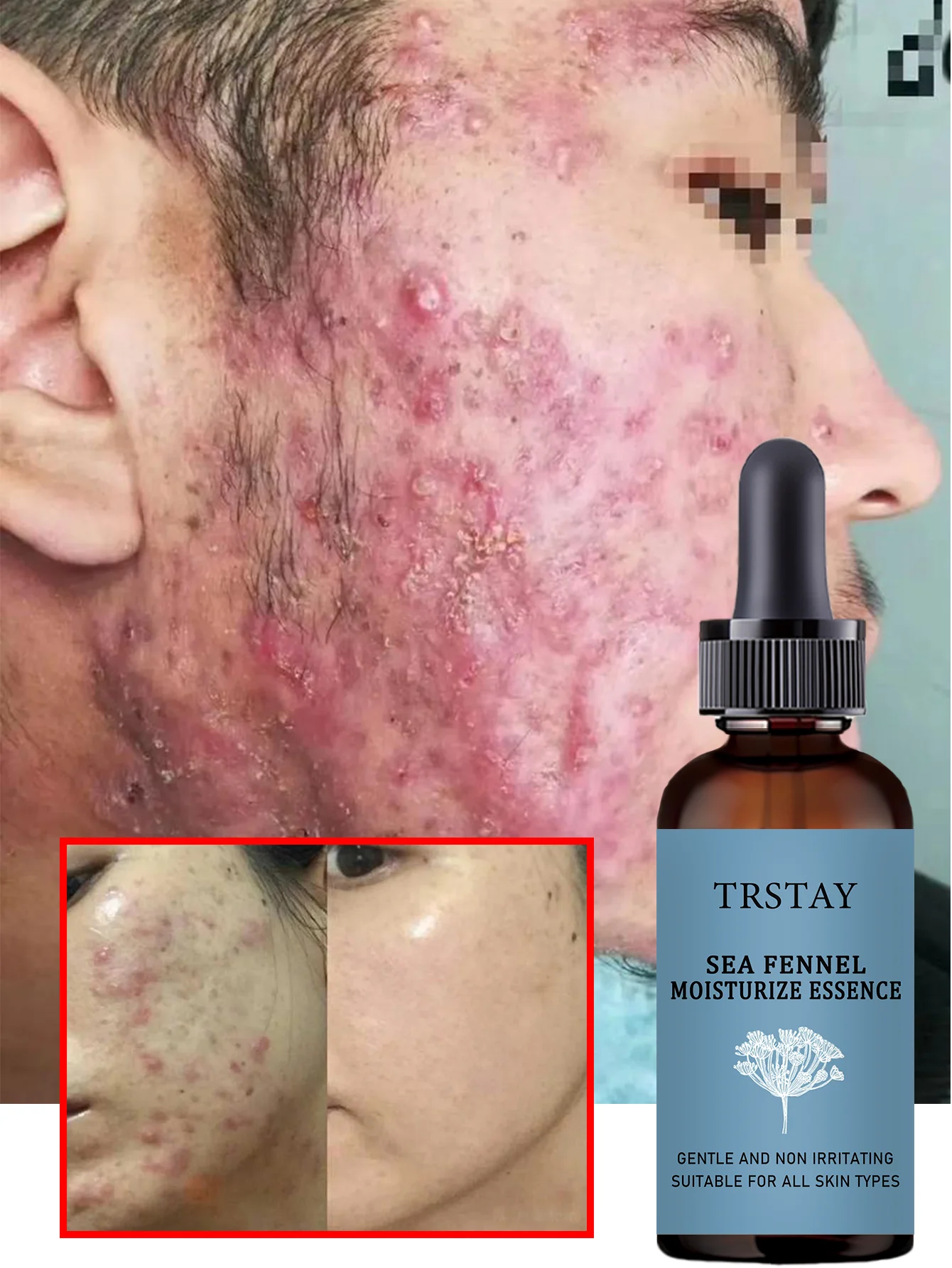 Acne-Fighting Essence, Unscented Formula, With Plant Extracts, Lightweight & Non-Greasy, Gentle & Non-Irritating, Suitable for A - Image 3