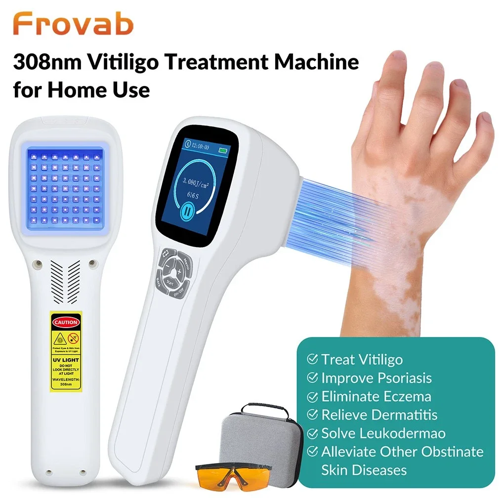 Frovab Handheld Excimer Ultraviolet Light Therapy Device for Vitiligo Psoriasis Eczema Skin Spot UVB Phototherapy Treatment