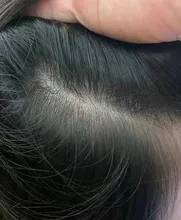 Roycederm