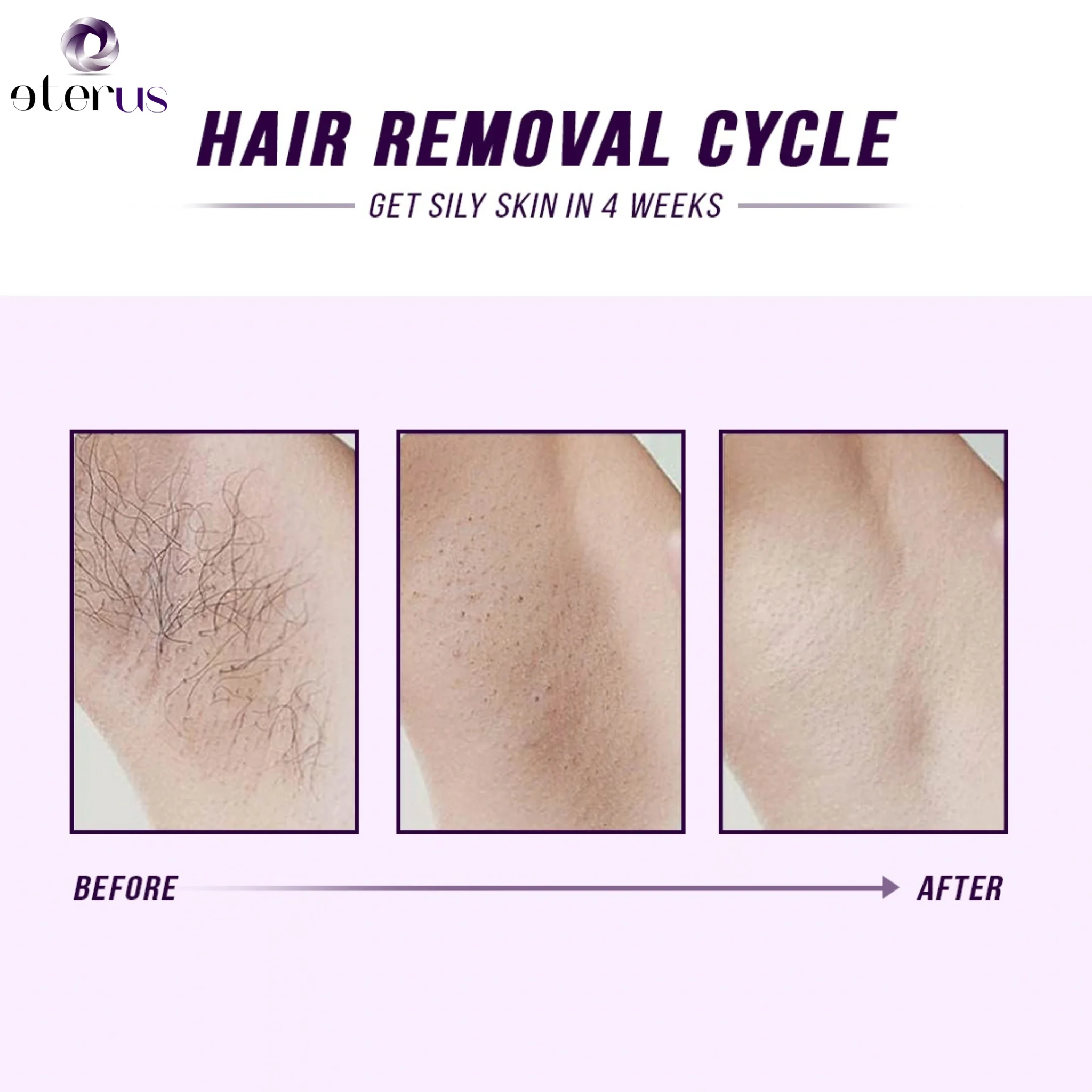 IPL Laser Hair Removal Handset - огляд і ціна Ipl Hair Removal Handset Permanent