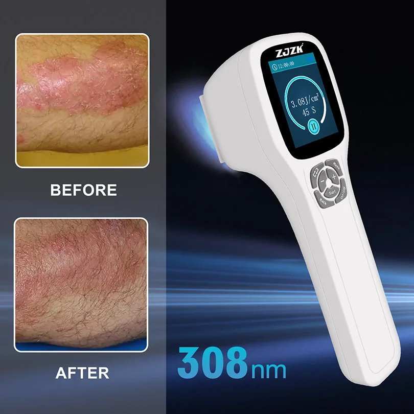 450mW อุปกรณ์การแพทย์ 308nm Uv โรคสะเก็ดเงิน Vitiligo Treatment Uvb Phototherapy 49 doides แนะนําโดยโรคผิวหนัง