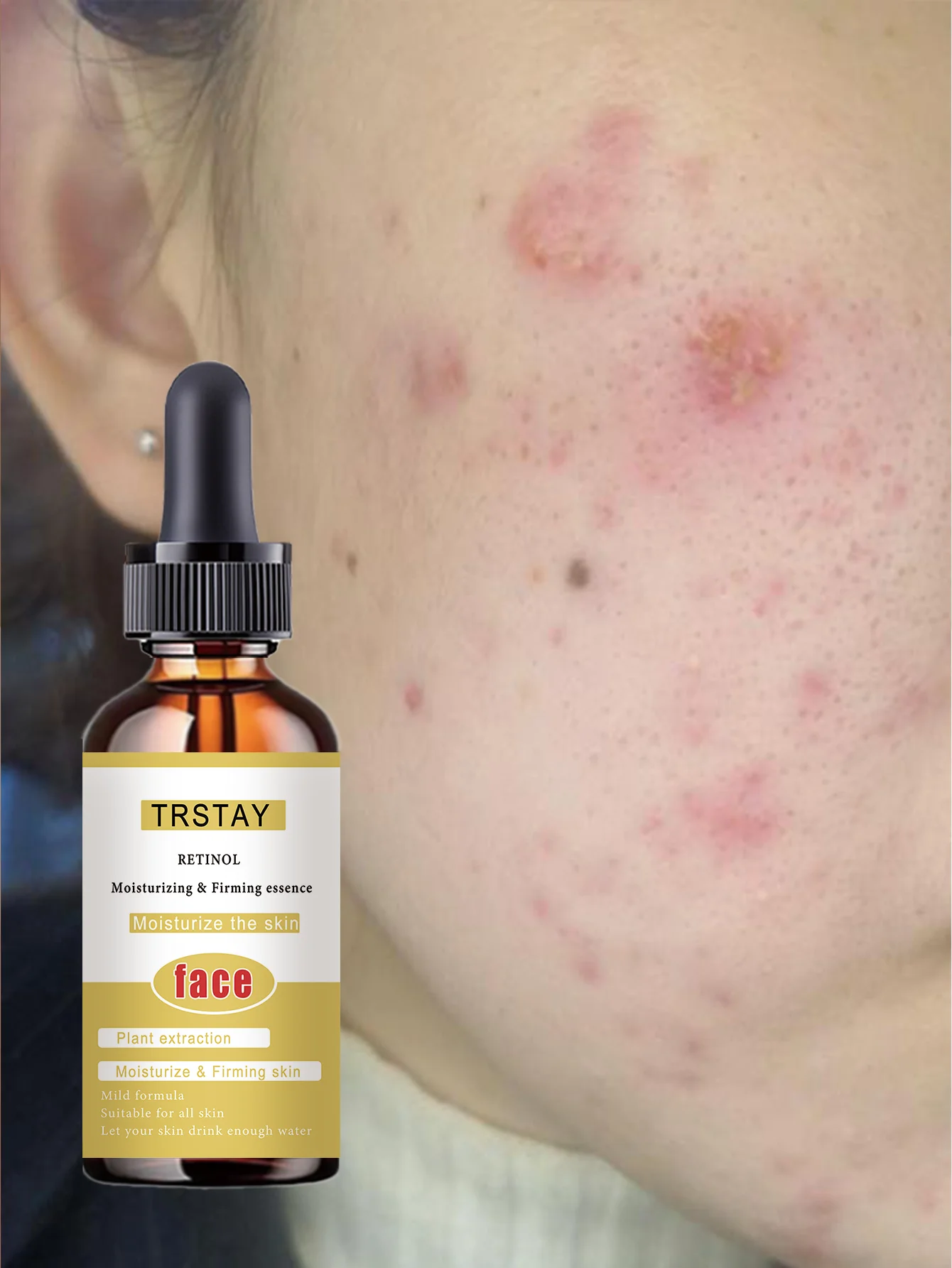 Acne-Fighting Essence, With Plant Extracts, Gentle & Non-Irritating, Fragrance-Free Skincare Product, Lightweight & Non-Greasy, - Image 2