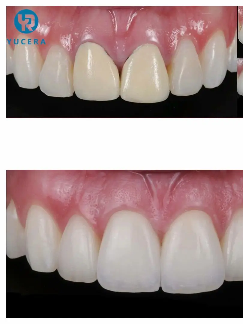 Super High Translucency Multilayer Dental Zirconia SHT-ML 98X16mm for full Contour Crown/Bridges