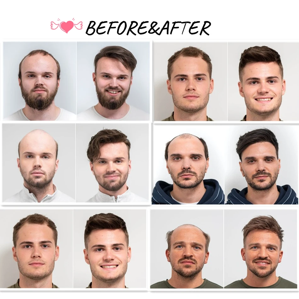 Man Haar Prothese 0.12-0.14Mm Injectie Huid Toupetje Mannen Duurzaam Pruiken Voor Mannen 100% Menselijk Haar Systeem Unit capillaire Prothese