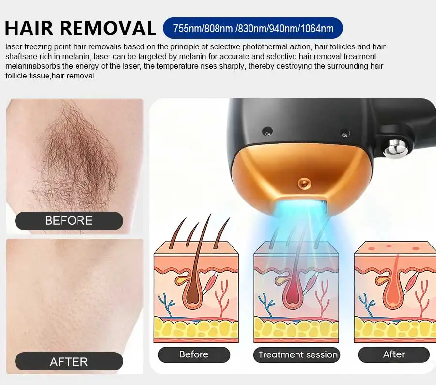 IPL Diode Laser RF Pico Technology Integrated 4-in-1 Advanced Skin Care Device Comprehensive Solution for Hair Acne and Wrinkl