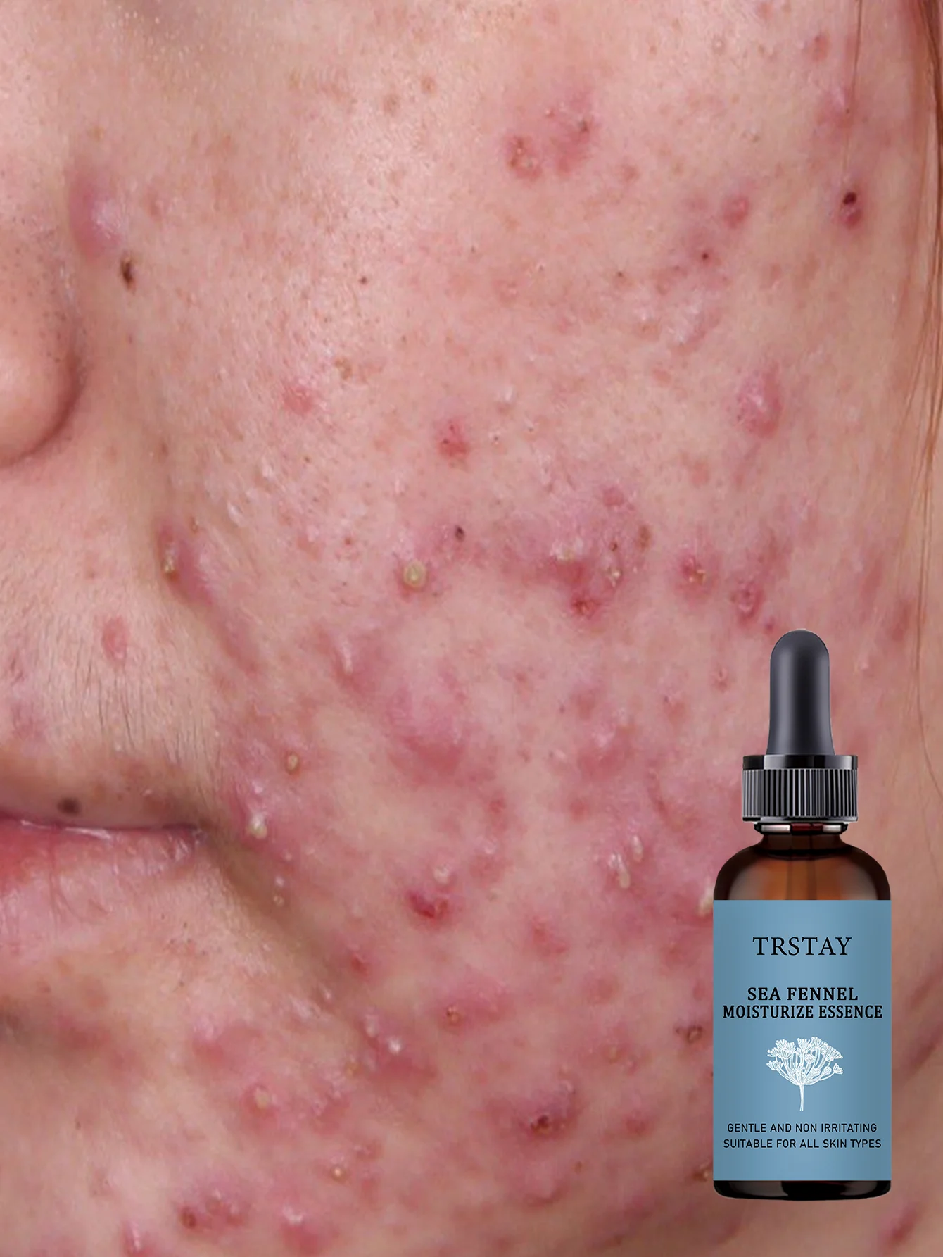 Acne-Fighting Essence, Unscented Formula, With Plant Extracts, Lightweight & Non-Greasy, Gentle & Non-Irritating, Suitable for A - Image 2