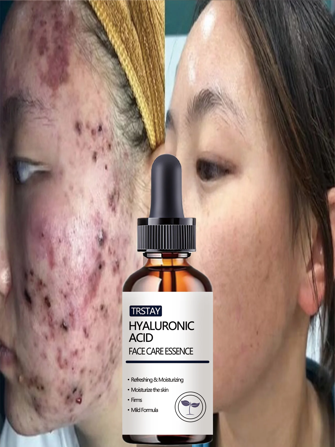 Acne-Fighting Essence, With Plant Extracts, Lightweight & Non-Greasy, Unscented, Suitable for All Skin Types, Hydrating, Gentle - Image 4