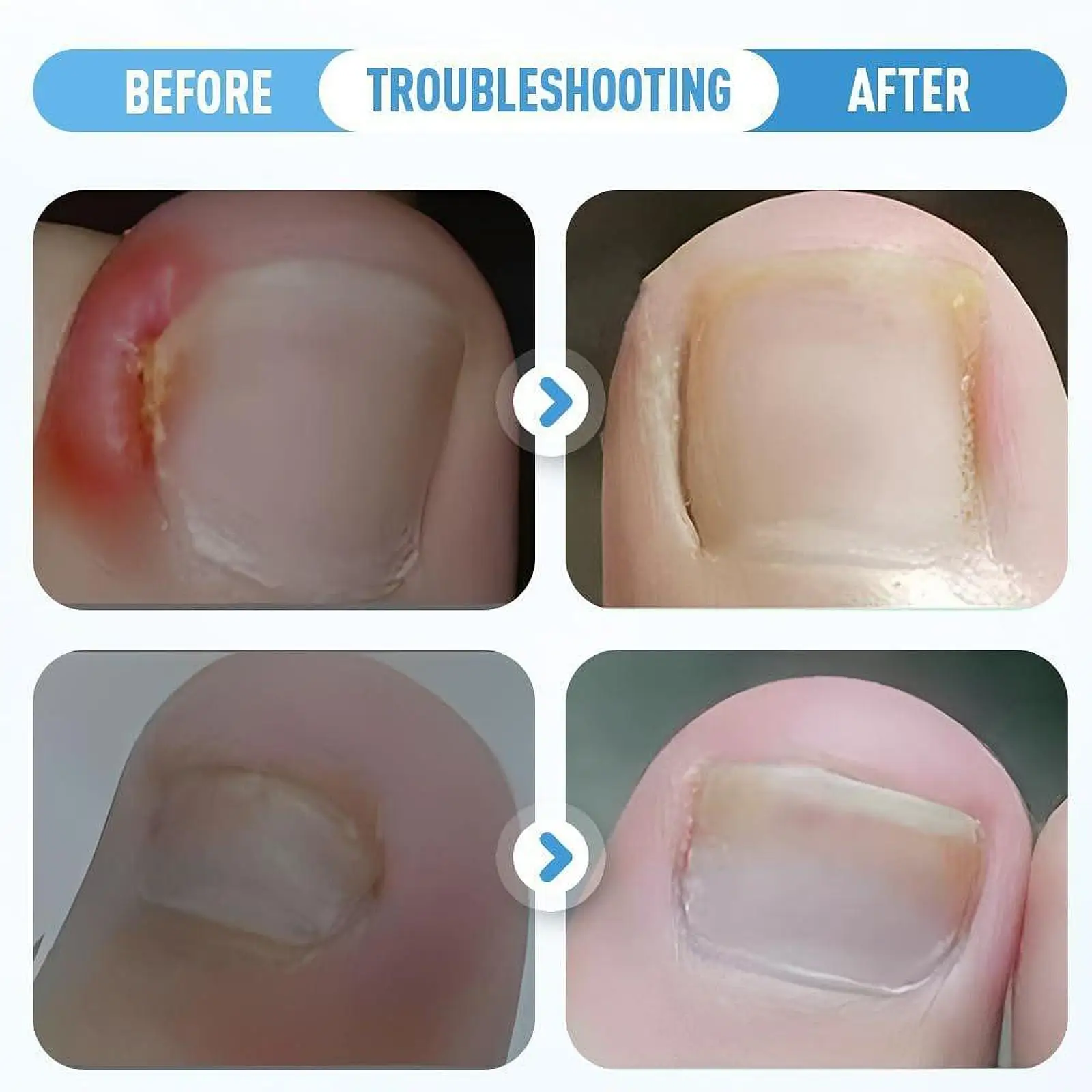 Ingrown Nail Correction Kit Nail Art Tools Elastic Breathable Ingrown Fingernail Corrector Professional Efficient For All Nail