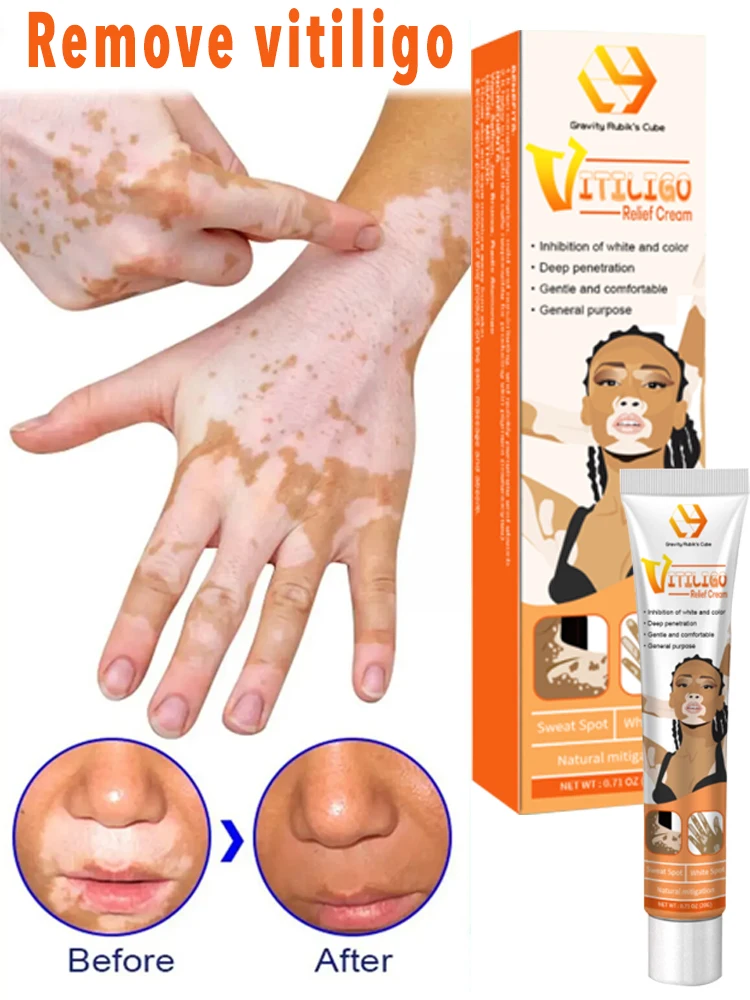 

Vitiligo Ointment Remove Ringworm White Spot Gel Removal Skin Vitiligo Eliminate Vitiligo External Skin Care Ointment 2024 New