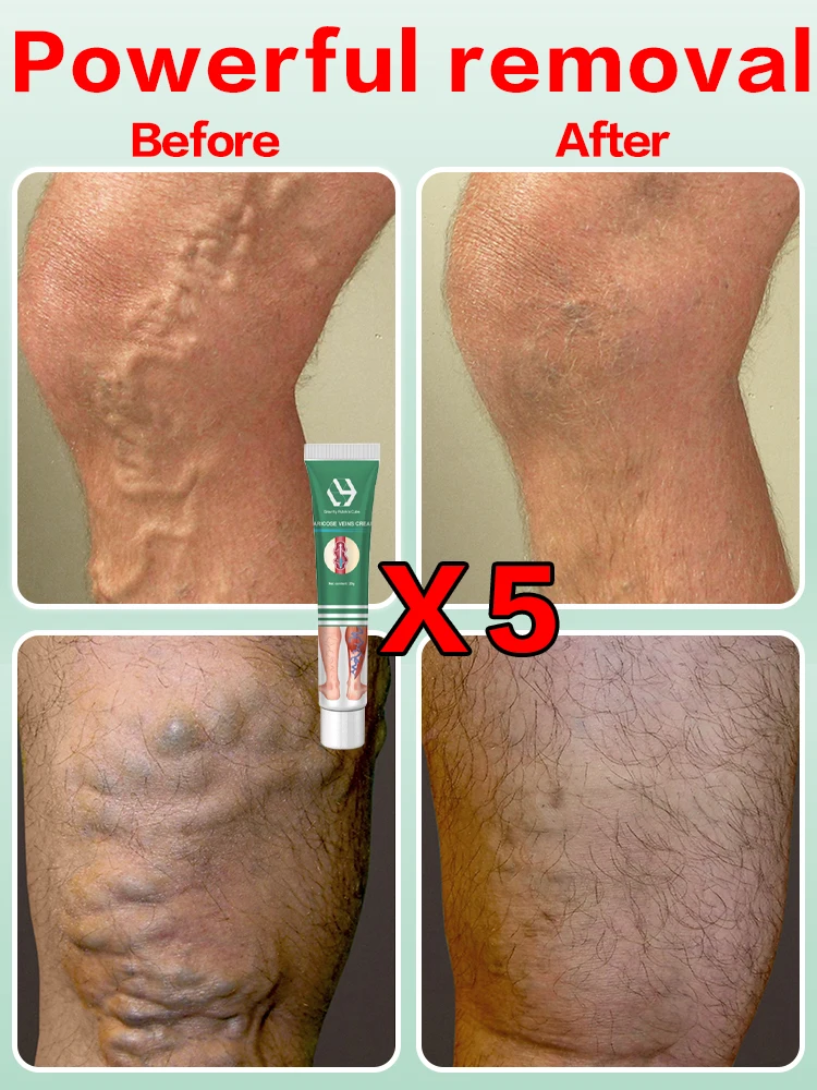 Ointment for Varicose Veins Eliminate Spider Legs Spider Vein to Relieve Vasculitis Phlebitis Spider Pain Treatment Varicose Vei