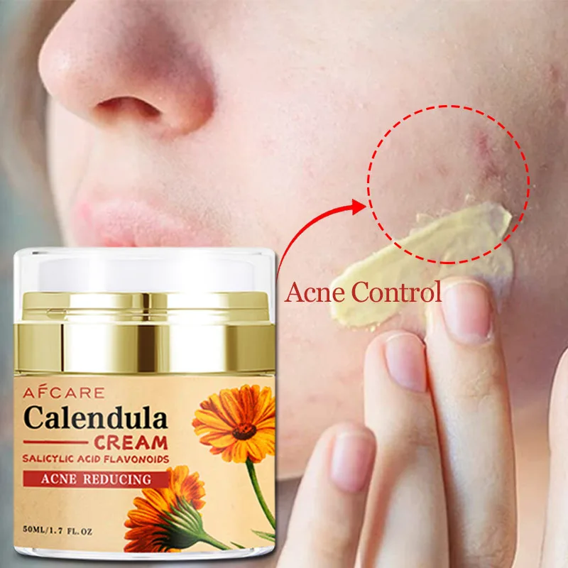 Natural Plant Calendula Face Cream Acne Oil Control Skin Care Suitable For Oily Skin Reduce Redness Heal Skin Irritation