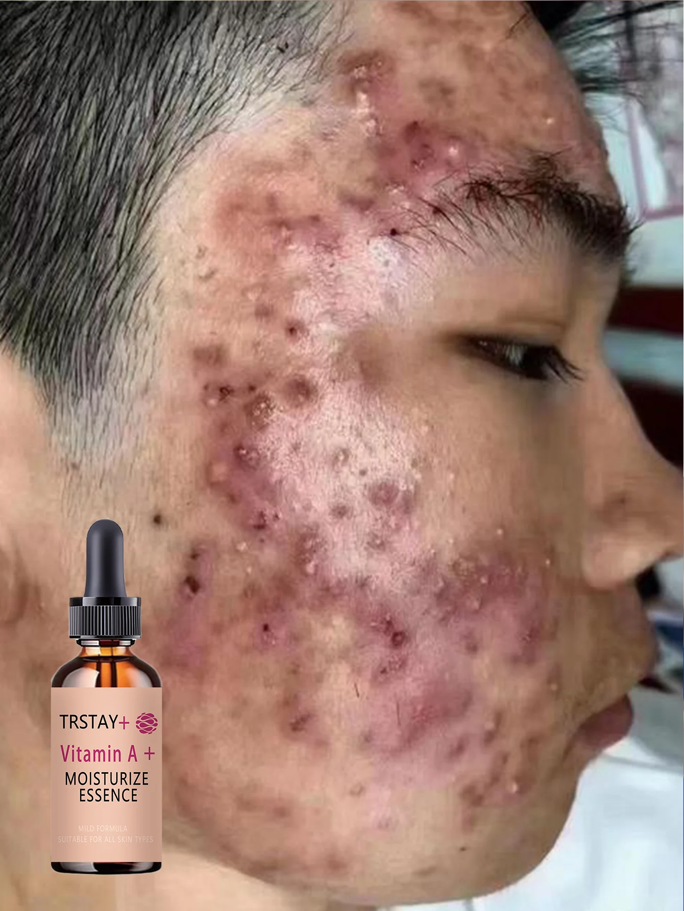 Acne-Fighting Essence, Fragrance-Free Skincare Product, With Plant Extracts, Gentle & Non-Irritating, Keeps Skin Hydrated, Light - Image 5