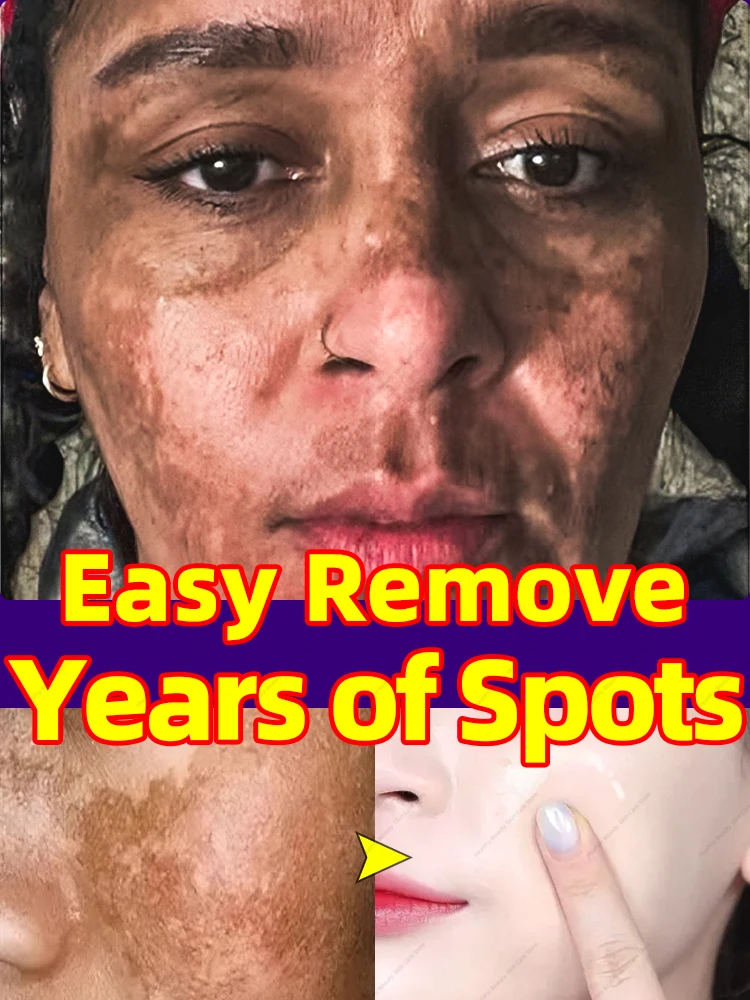 dark spots remover cream for melasma on the face