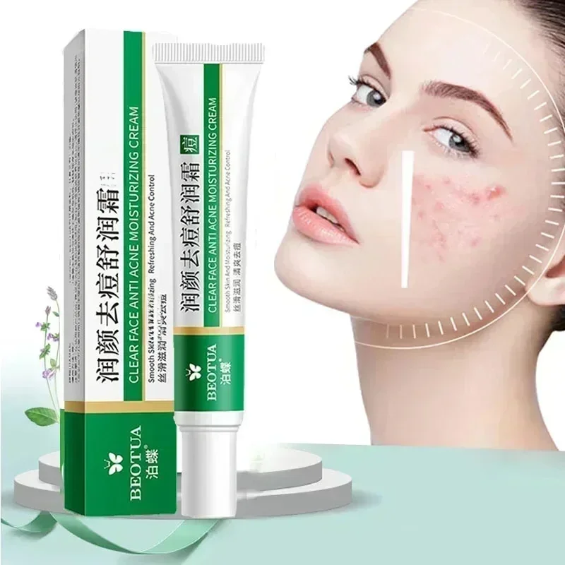 Crème de traitement de l'acné à base de plantes, dissolvant de cicatrices du visage, Gel réparateur, contrôle de l'huile, rétrécissement des Pores, blanchiment des Pores, soins pour la peau,