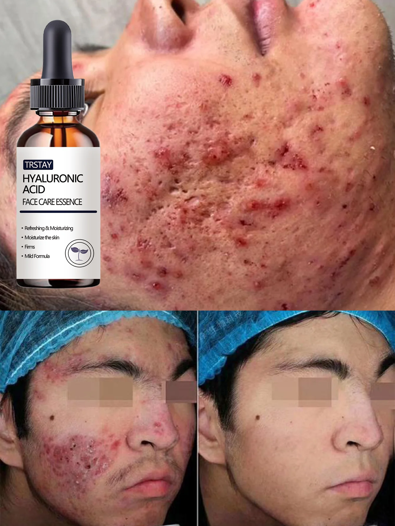 Acne-Fighting Essence, With Plant Extracts, Lightweight & Non-Greasy, Unscented, Suitable for All Skin Types, Hydrating, Gentle - Image 6