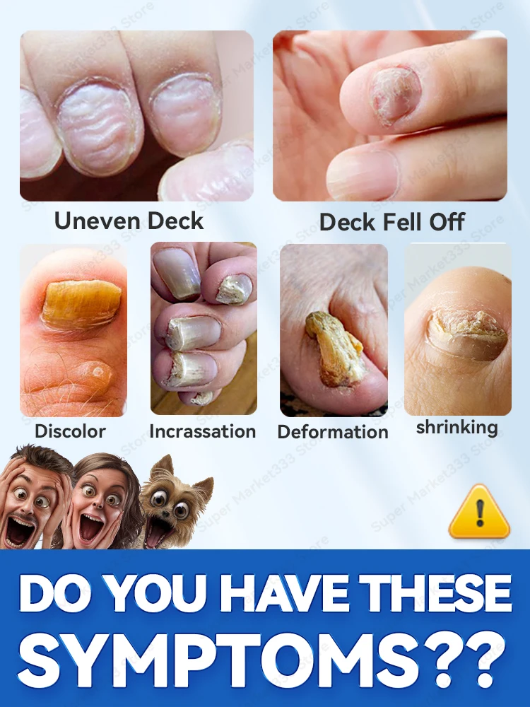 Fungus Nails Fungal Nail Repair Fast Onychomycosis resumption