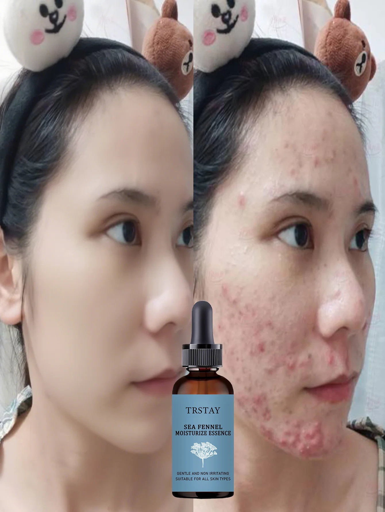 Acne-Fighting Essence, Unscented Formula, With Plant Extracts, Lightweight & Non-Greasy, Gentle & Non-Irritating, Suitable for A - Image 5