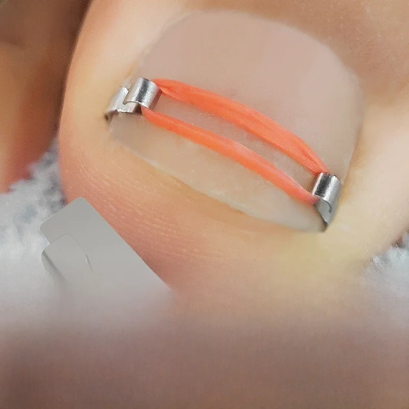 Patch professionnel pour traitement des ongles incarnés, outil de soin des pieds, pédicure, gélatine Parker