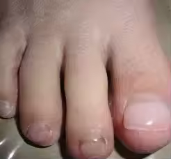 Después FungiDerm