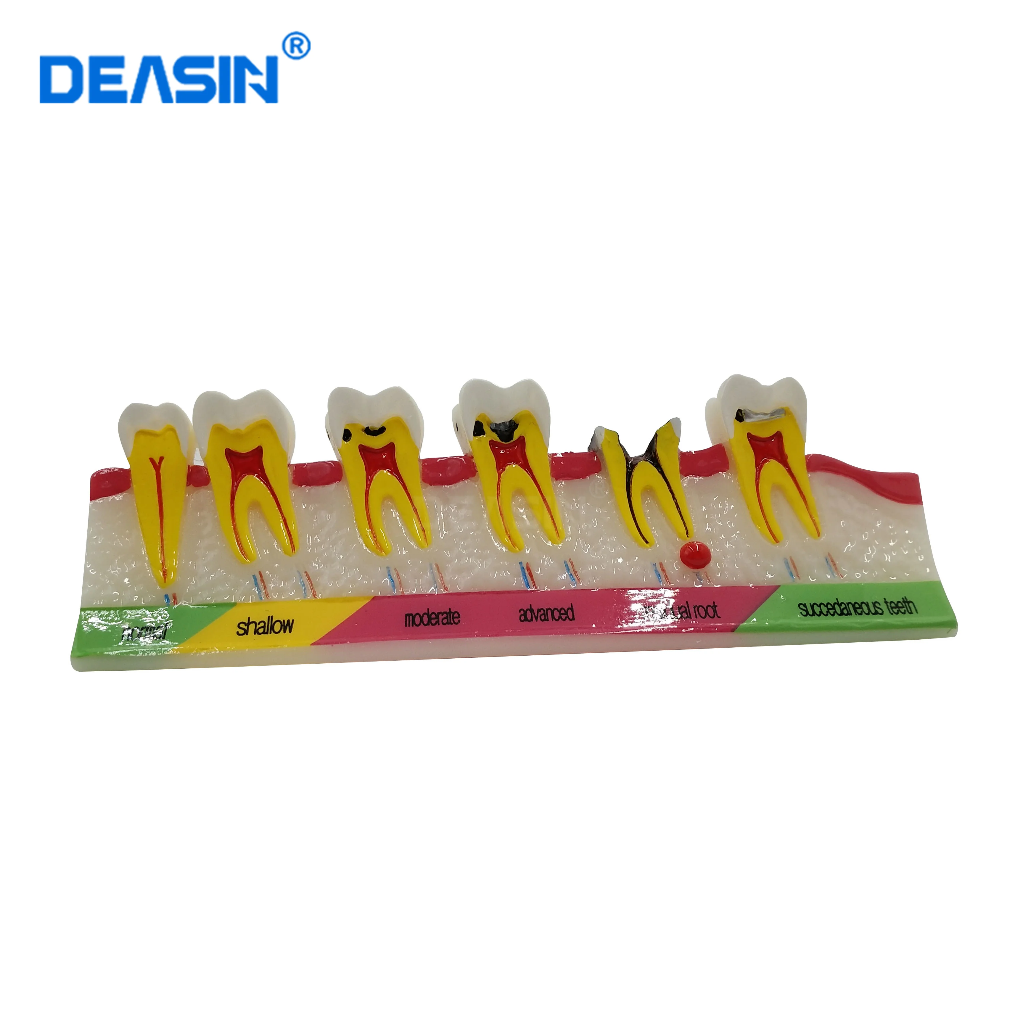 High Quality 1Pc Dental Caries Developing illusteation teeth disease Tooth Model Demonstration Teach Patient Toiletry