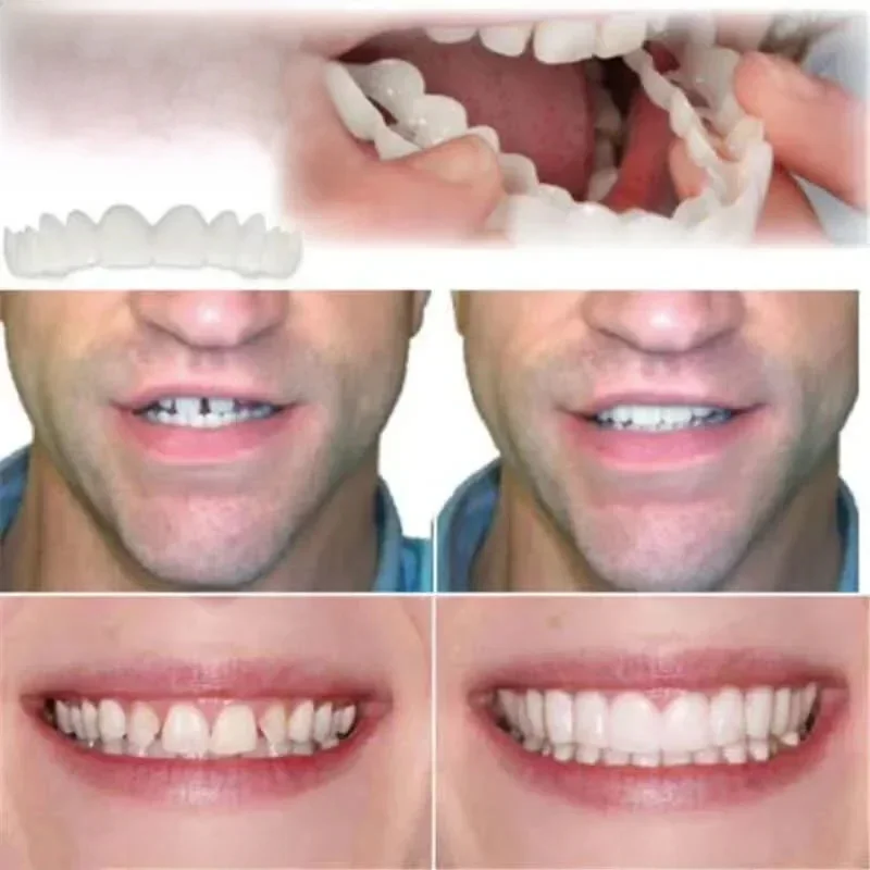 Ensemble de prothèse dentaire supérieure et inférieure avec boîte, accolades orthodontiques, blanchiment des dents en silicone, accolades de couverture de dents, simulation