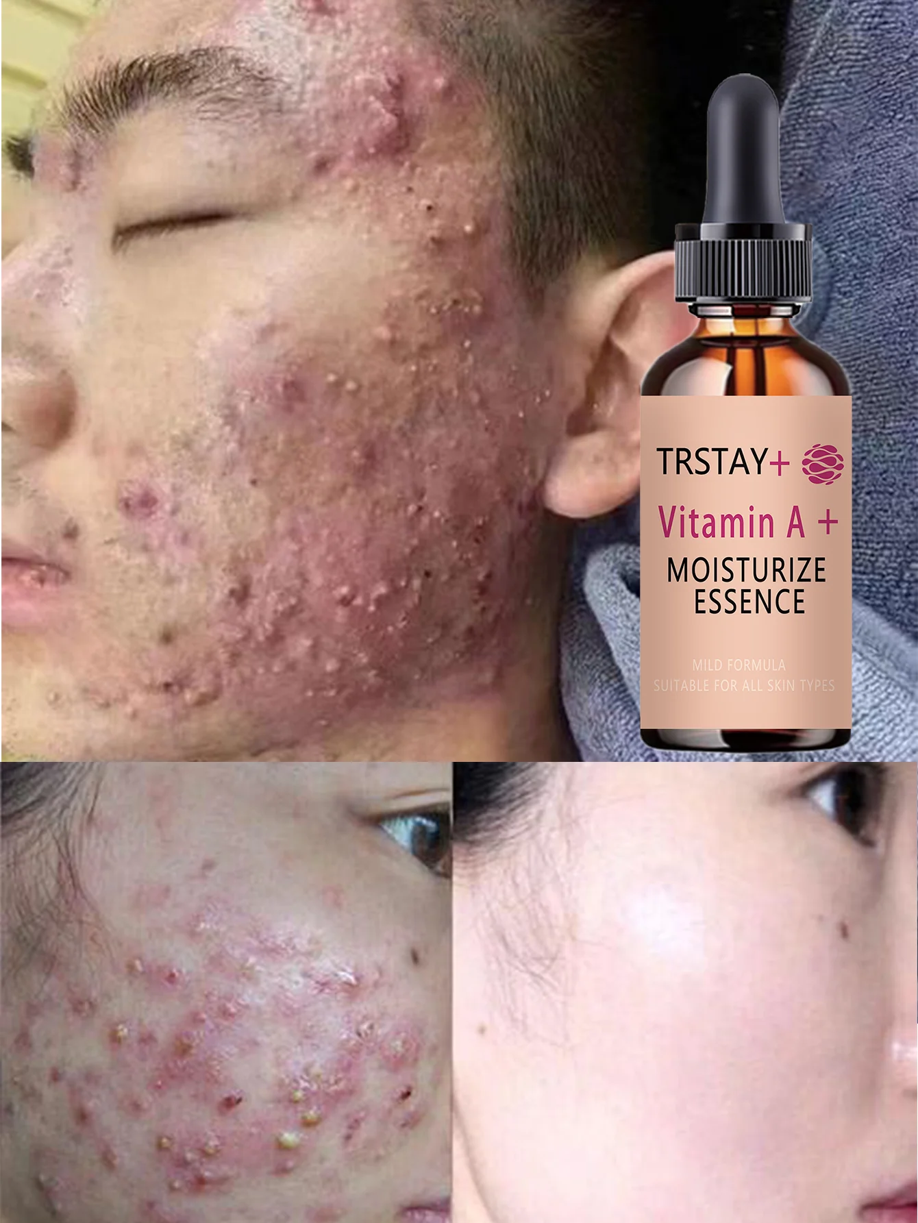 Acne-Fighting Essence, Fragrance-Free Skincare Product, With Plant Extracts, Gentle & Non-Irritating, Keeps Skin Hydrated, Light