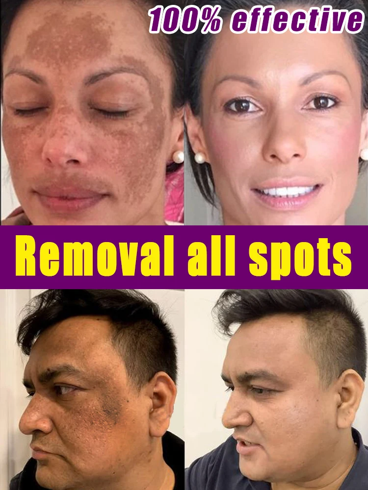 

Dark Spot Remover Cream Removal Deep Melasma Freckle Age Sun Spots Whitening For Face