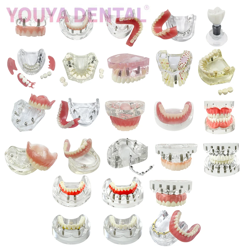 

Модель зубного имплантата, съемный протез верхней/нижней части челюсти, модель восстановления моста Мэриленд, обучающая демонстрационная модель Typodont