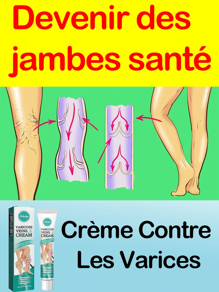 

Effective varicose vein soothing cream. Vasculitis, phlebitis, spider leg soothing cream