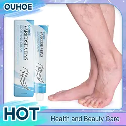 Relieve Vasculitis Cream Phlebitis Worm Spider Legs Vessel Pain Treatment Soothing Reduce Swelling Varicose Vein Relief Ointment