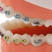 

Dental Standard Model Teeth with Orthodontic Braces Channeled Steel Wire Buccal Tube Dentisit Teaching Demonstration Tool