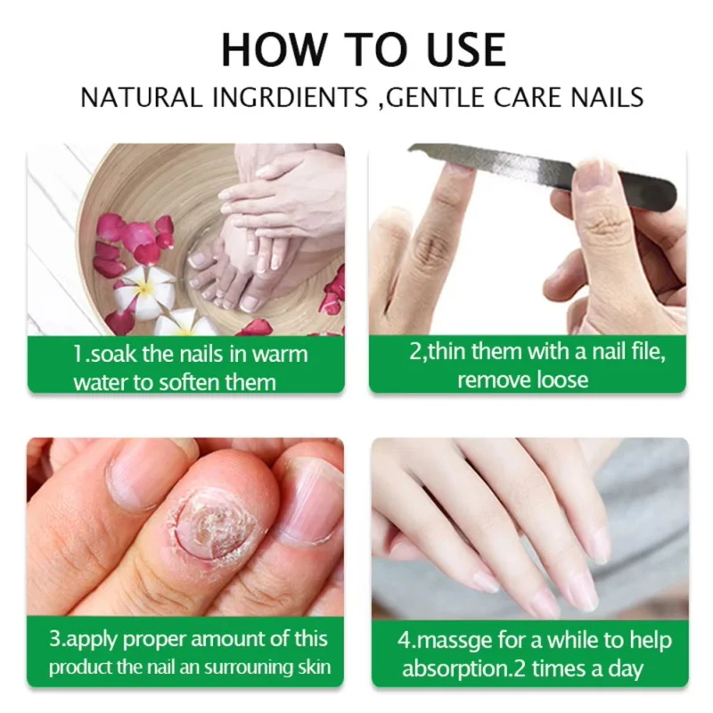 Fungal Nail Treatment Oil Foot Repair Essence เจลกําจัดเชื้อราเล็บเท้า ครีมป้องกันการติดเชื้อ Fungal Nail Removal