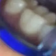 

Mouth Openermouth Dental Orthodontic Braces Lip Cheek Retractor Expander Dental Mouth Oral Tooth Tool Care Orthodontic Accessory