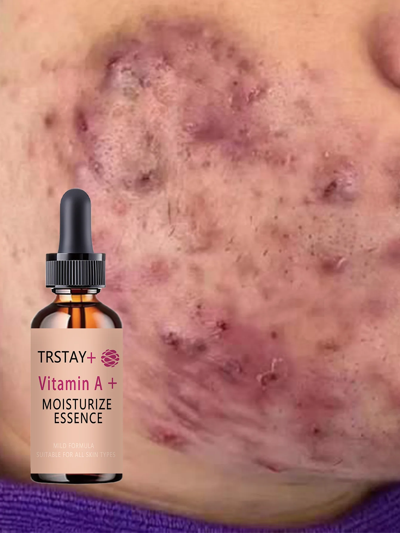 Acne-Fighting Essence, Fragrance-Free Skincare Product, With Plant Extracts, Gentle & Non-Irritating, Keeps Skin Hydrated, Light - Image 6