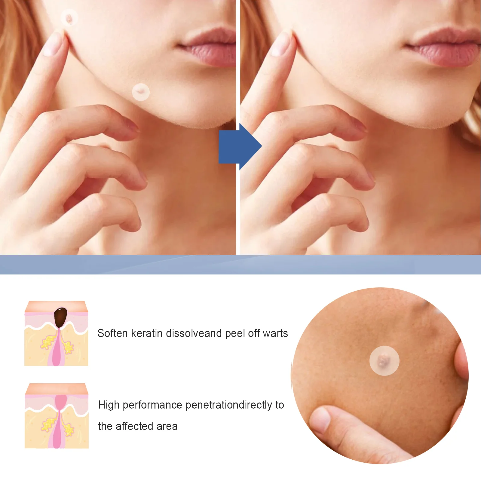 Eelhoe Skin Tag Patch schiarente e scuro nevo Meat Grain Smooth Skin Cover Acne e Dark nevo Kerb Care Patch