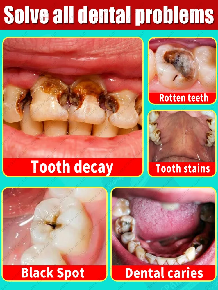 Mousse de dente anti-cárie, Reparação de cárie, Prevenção de cárie, Proteger os dentes, Dente Respiração Fresca