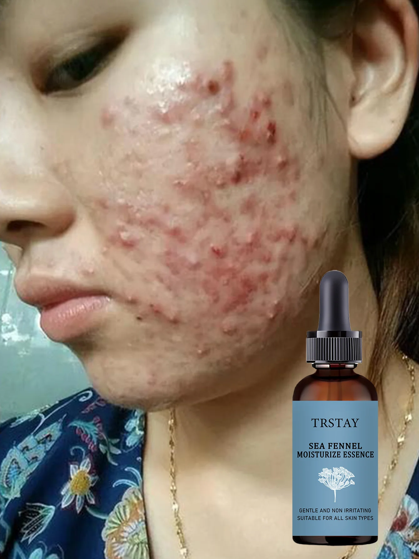 Acne-Fighting Essence, Unscented Formula, With Plant Extracts, Lightweight & Non-Greasy, Gentle & Non-Irritating, Suitable for A - Image 6