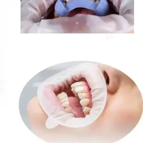 

3D Dental Mouth Opener Oral Lip Cheek Retractor O Shape Rubber Mouth Opener Expander Regular/Small/Junior Dentistry Tools