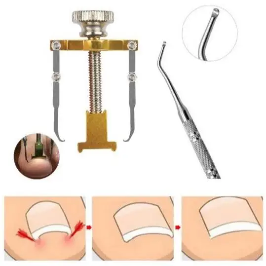 Kit Corrector Reparador de Uñas Encarnadas + Varilla Pedicura Ortoprime Ortoprime