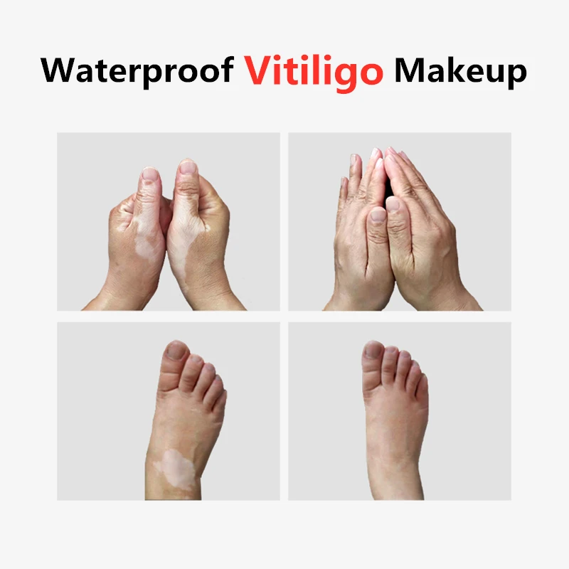 Waterproof Vitiligo Concealer Safety Natural Face Body Skin Vitiligo Covering Pen Makeup